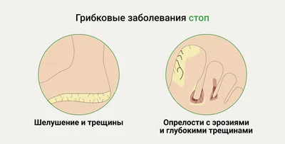 Грибок ногтей на ногах: стадии, лечение, профилактика в домашних условиях