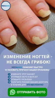 Лечение грибка ногтей, цены в Москве – лечение грибка стоп на ногах в  клинике MedNail