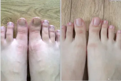 Противогрибковое средство Акрихин Микозорал Мазь - «Как вылечить грибок  ногтей на ногах? Не поверите - противогрибковой мазью!))) + фото до и  после» | отзывы