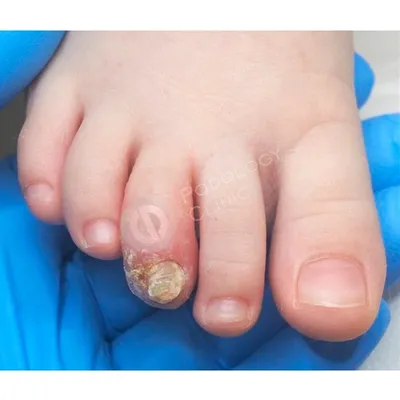 Запущенный грибок ногтей на ногах (47 фото)
