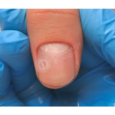 Грибок ногтей на руках | Эффективное лечение грибка на пальцах рук в Москве  | Цены на лечение в Клинике подологии Полёт