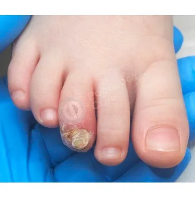 Грибок ногтя у ребенка: причины, симптомы и лечение