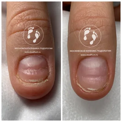 Лечение ногтей на руках | Московская Клиника Подологии