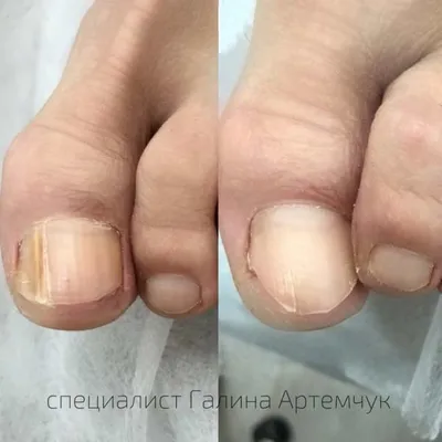 Лечение грибка ногтей в Киеве. Цена от 450грн. Лазер Fotona