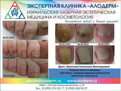 Грибок ногтей - лечение в Самаре | Клиники доктора Кравченко