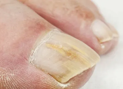 Взятие соскоба с кожи и ногтей на грибок - «Соскоб на грибок ногтей|Как  подготовиться к анализу и стоит ли ему доверять? Фото не для  впечатлительных » | отзывы