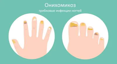 Лечение грибка ногтя