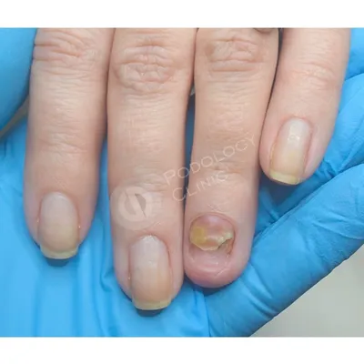 Грибок ногтей на руках | Эффективное лечение грибка на пальцах рук в Москве  | Цены на лечение в Клинике подологии Полёт
