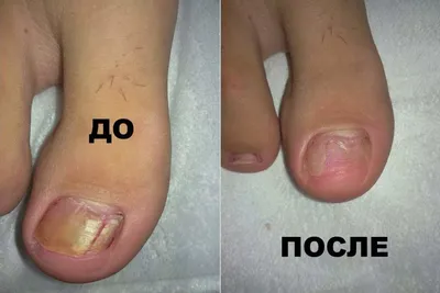 Лечение грибка ногтей на ногах (онихомикоза) лазером – цены на услугу в  Химках, Эстетика Групп (Москва и МО)
