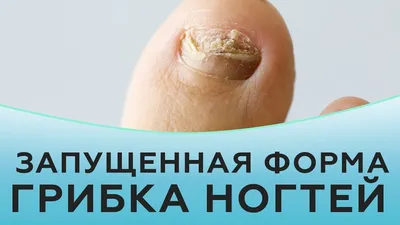 Лечение грибка стопы | Уход от грибка ногтей - Nailyuba