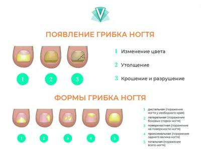 Онихолизис ногтей: виды, причины, симптомы и лечение. Как связаны  онихолизис и гель-лак?