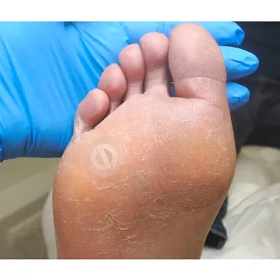 Грибок на ногах: лечение грибка ногтей в Москве | Лечение запущенного  грибка на пальцах и стопах ног в Клинике подологии Полёт
