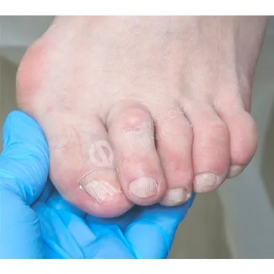 Грибок на ногах: лечение грибка ногтей в Москве | Лечение запущенного  грибка на пальцах и стопах ног в Клинике подологии Полёт