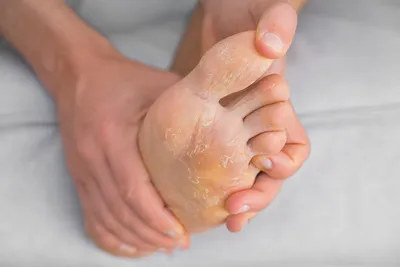 Грибок стопы: причины, симптомы, диагностика и лечение грибка на ногах,  руках и ногтях в Москве - сеть клиник «Ниармедик»