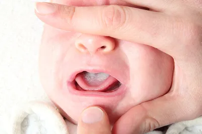 Молочница во рту – как выглядит, симптомы, причины, чем лечить у взрослых и  у ребенка