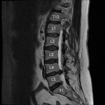 Грыжа позвоночника на МРТ - что покажет, признаки, снимки