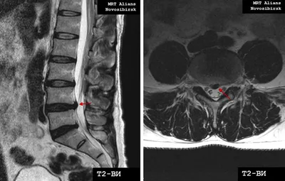 Как болит межпозвонковая грыжа диска позвоночника