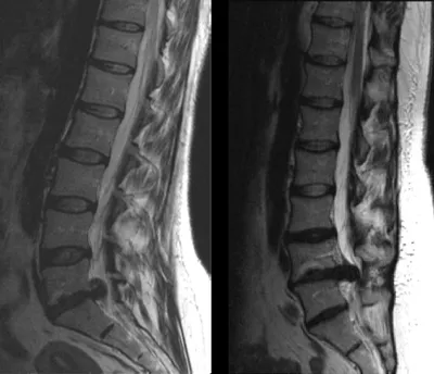 МРТ позвоночника (шейного, грудного, пояснично-крестцового отделов)