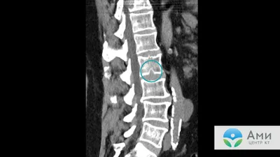 Диагноз мрт позвоночника: норма или патология | Второе мнение