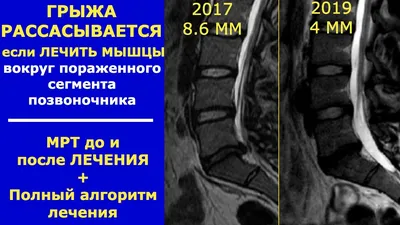 Грыжа Шморля. Словарь терминов лучевой диагностики