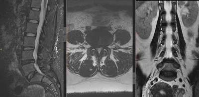 Грыжа позвоночника на МРТ снимках | MRT-V | Дзен