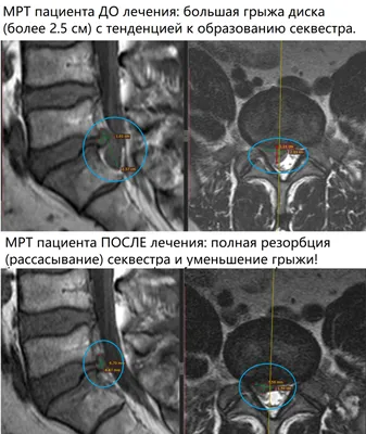 Резорбция грыжи диска позвоночника