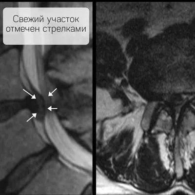 Результаты лечения межпозвонковых грыж и протрузий без операции, снимки МРТ  до и после, отзывы - Vertebra