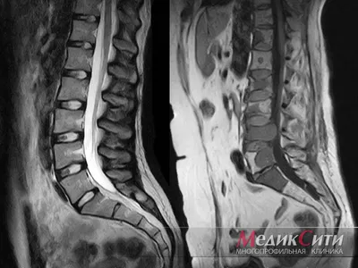 Видна ли грыжа позвоночника на МРТ? МЦ «Малахит»