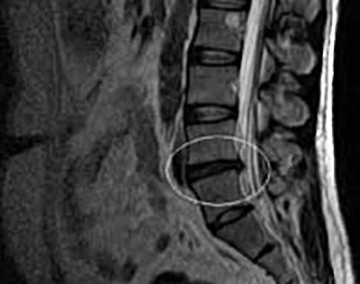 Stories of the treatment of intervertebral hernias and protrusions of our  patients without surgery, their MRI results and reviews - Vertebra