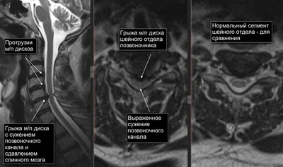 Микродискэктомия при фораминальной грыже диска L5-S1 справа