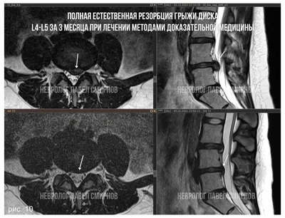 МРТ позвоночника (шейного, грудного, пояснично-крестцового отделов)