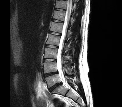 Магнитно-резонансная томография (МРТ) позвоночника