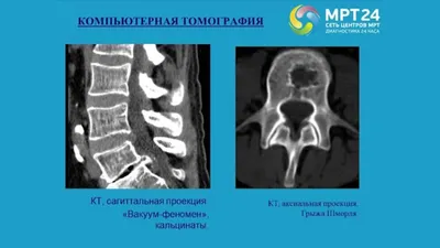 МРТ грудного, шейного, поясничного отдела - что показывает у женщин и  мужчин, как расшифровать заключение МРТ позвоночника