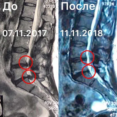 Мрт Позвоночника Человека С Указанием Позвонка В Медицинском Сканировании —  стоковые фотографии и другие картинки Грыжа межпозвоночного диска - iStock