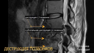 Грыжи дисков поясничного отдела позвоночника - Федеральный центр  нейрохирургии, г. Новосибирск