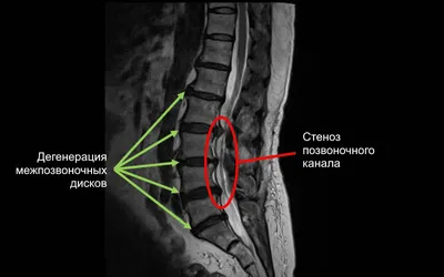МРТ позвоночника по акции в Москве со скидкой, сделать томографию  позвоночника по акции недорого | Центр Дикуля