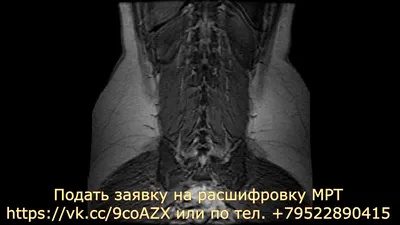 МРТ шейного отдела позвоночника - цена в Москве, сделать  магнитно-резонансную томографию
