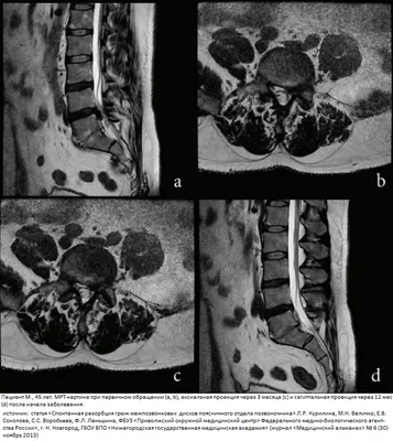 МРТ пояснично-крестцового отдела позвоночника