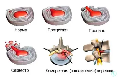 МЕЖПОЗВОНОЧНЫЕ ГРЫЖИ и СТЕНОЗЫ ПОЗВОНОЧНОГО КАНАЛА