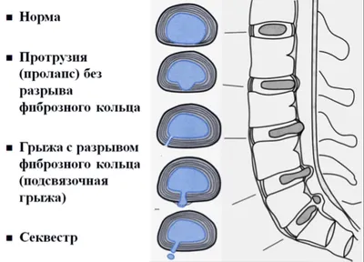 МЕЖПОЗВОНОЧНЫЕ ГРЫЖИ и СТЕНОЗЫ ПОЗВОНОЧНОГО КАНАЛА