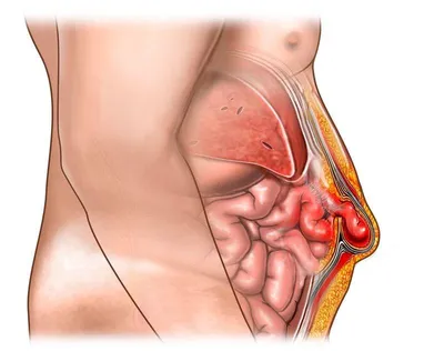 Послеоперационная грыжа: лечение, пластика, операция по удалению в СПб -  цена