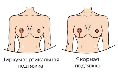Подтяжка груди: цены от 197 200 руб. в Москве | Мастопексия в «Номосклиник»
