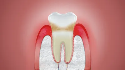 Опухла десна около зуба основные причины вздутия и воспаления | Дали