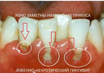 Гнойник на десне - причины, симптомы, признаки, диагностика, лечение,  профилактика абсцесса десны