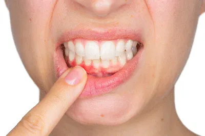 Белые язвочки во рту: почему появляются и как от них избавиться | Dental Art