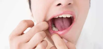 Ребенок, имеющих вздутое нижний Winth губы инфекция с гной, вызывая язвы  ротовой полости Стоковое Фото - изображение насчитывающей причинять,  взорвать: 210807918