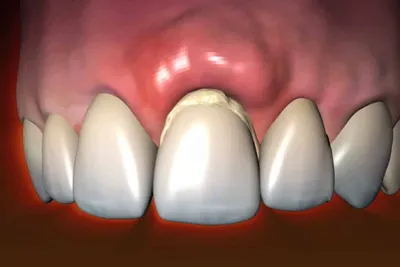 Удаление дистопированного зуба в Ярославле - Стоматологическая клиника  \"Голливуд\"