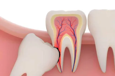 Киста зуба - что это, причины кисты зуба, стадии, симптомы, виды и лечение  кисты