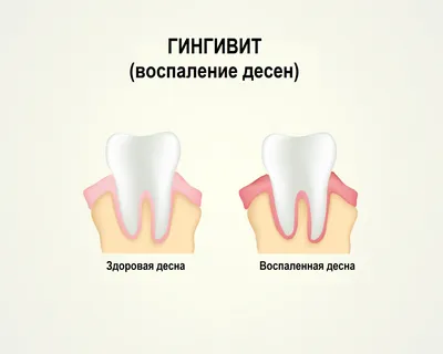 Воспаление десен - виды, причины, симптомы, признаки, лечение, профилактика