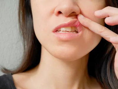 Во рту появилась белая язвочка: как лечить | Dental Art